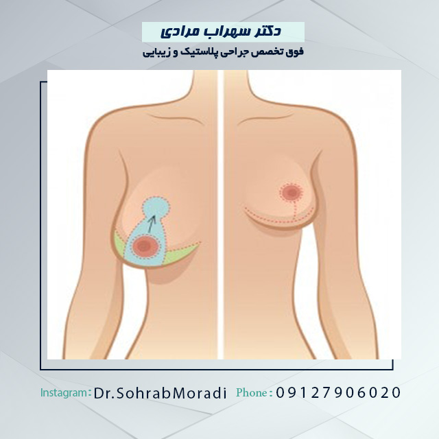 لیفت سینه