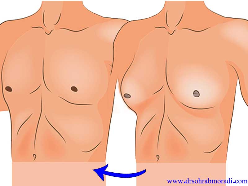 کوچک کردن سینه مردان با جراحی ژنیکوماستی