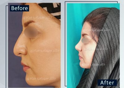 نمونه کار عمل زیبایی بینی توسط دکتر سهراب مرادی